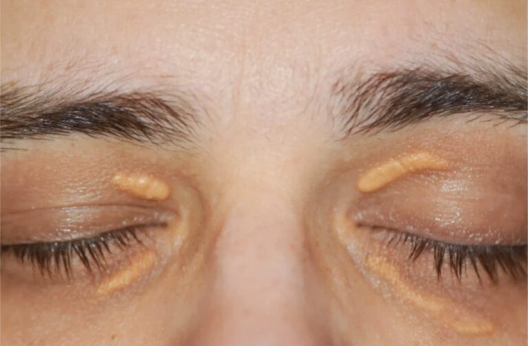 Xanthelasma Surgery & Removal in Mira Road & Mumbai