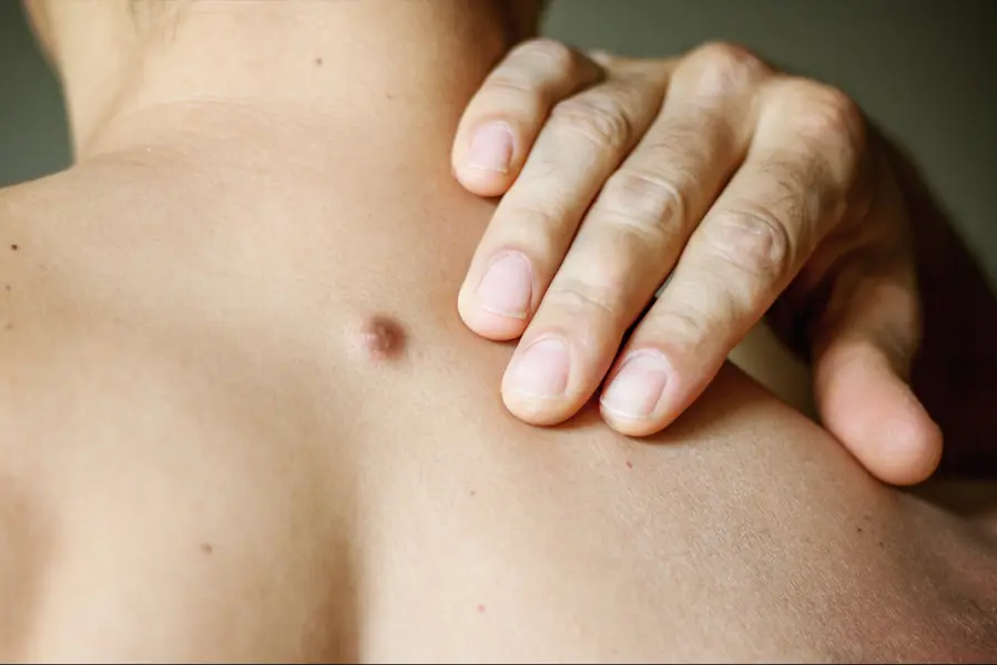 cyst on man's back