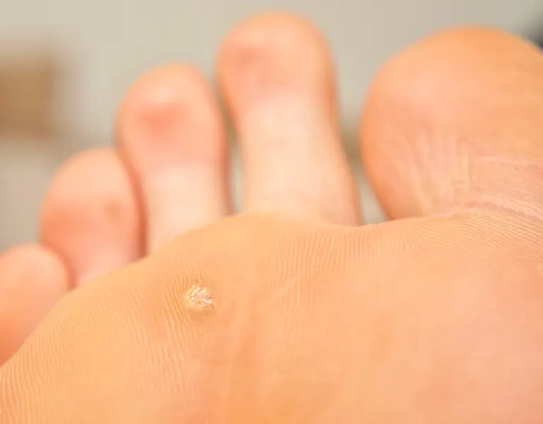 wart on bottom of foot