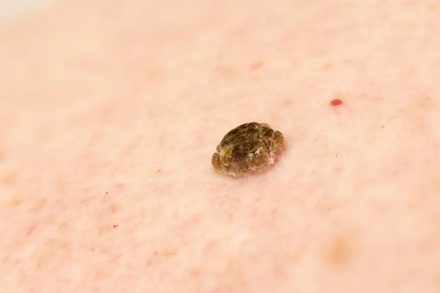 dark seborrheic mole