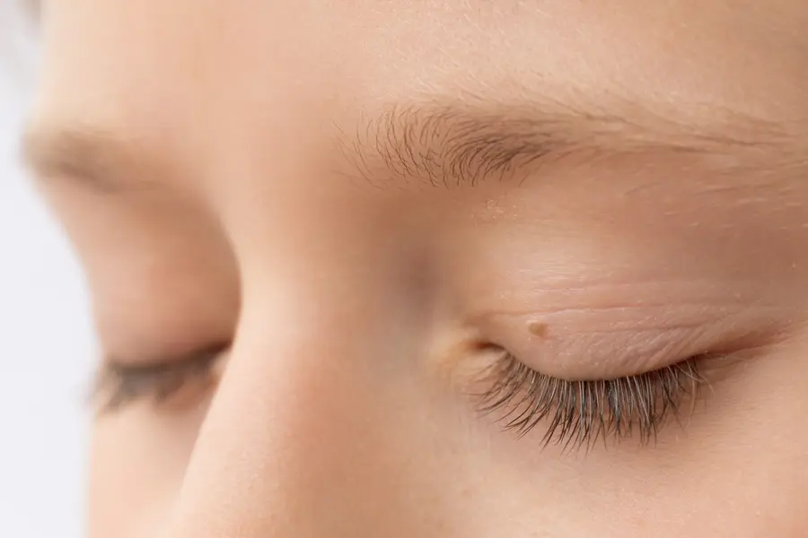 skin tag on woman's eye lid