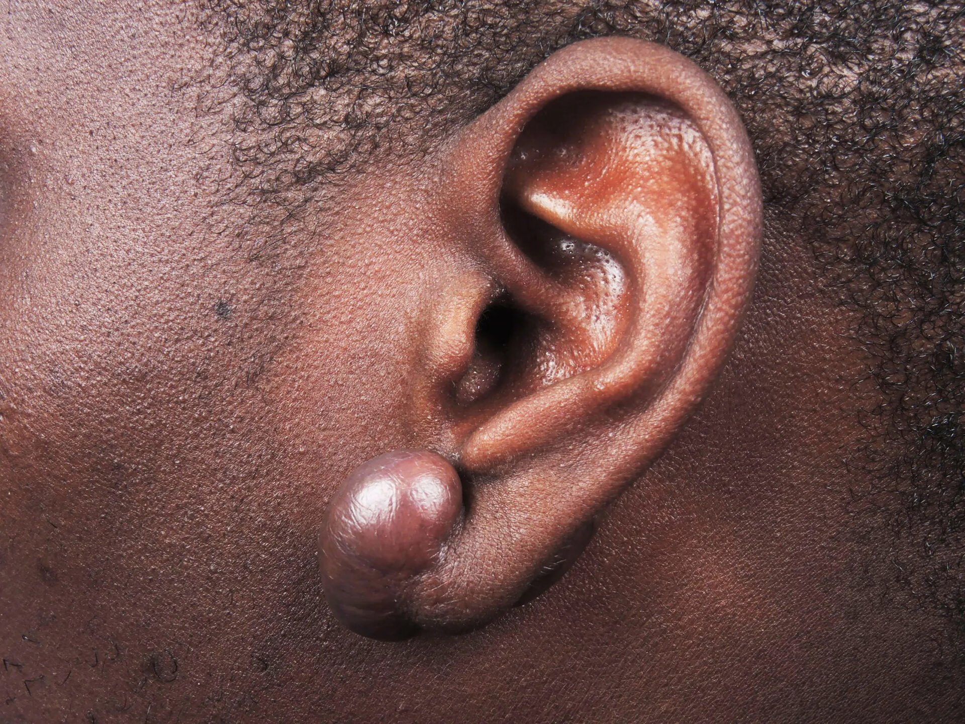 thunb with ganglion
