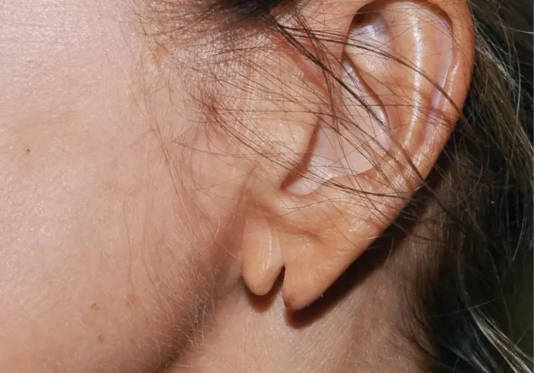 picture of a patient with split earlobe